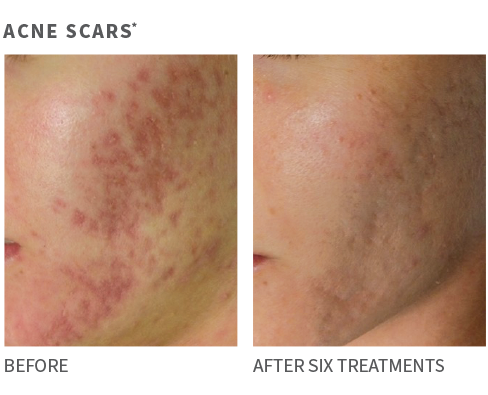 Acne Scars - Before and After 6 treatments.